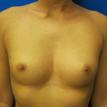 Breast Augmentation Case 6 - Before