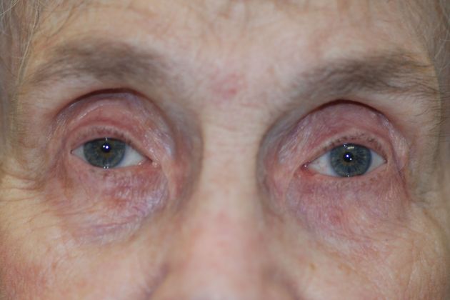 Ptosis Repair Case 31 - After