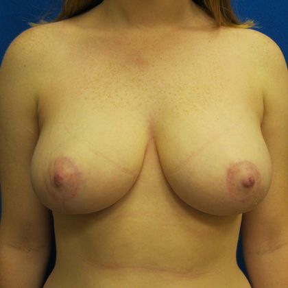 Breast Reduction Case 1 - After