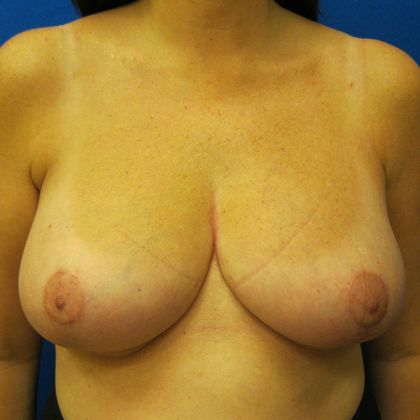 Breast Reduction Case 2 - After