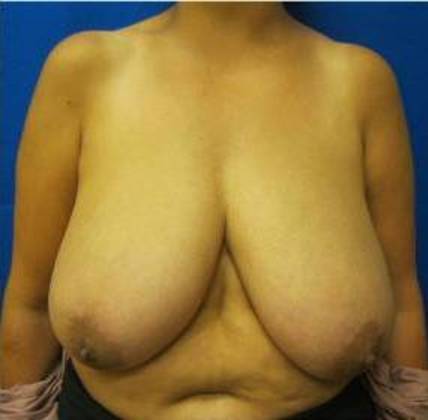 Breast Reduction: Case 5 - Before