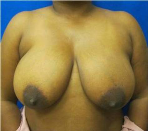 Breast Reduction: Case 7 - Before