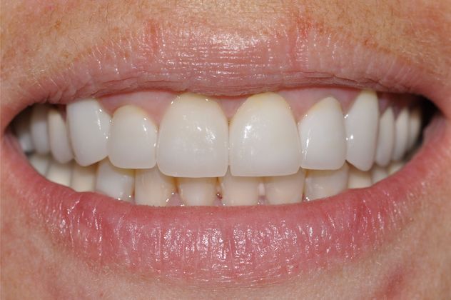 Porcelain Veneers Case 2 - After