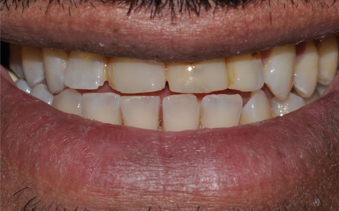 Crowns: Michael - Before