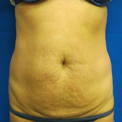 Tummy Tuck Case 8 - Before