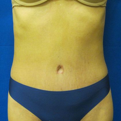 Tummy Tuck Case 8 - After