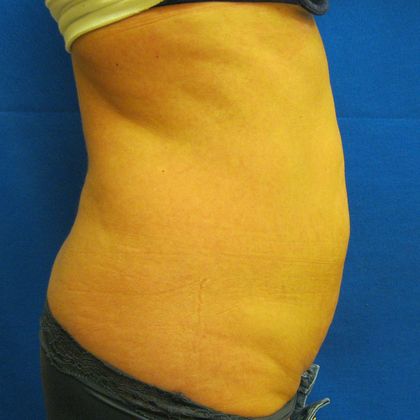 Tummy Tuck: Case 8 - Before