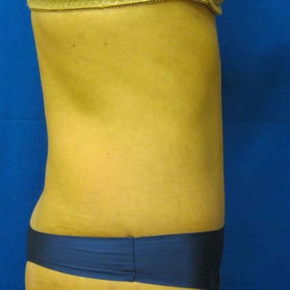 Tummy Tuck: Case 8 - After