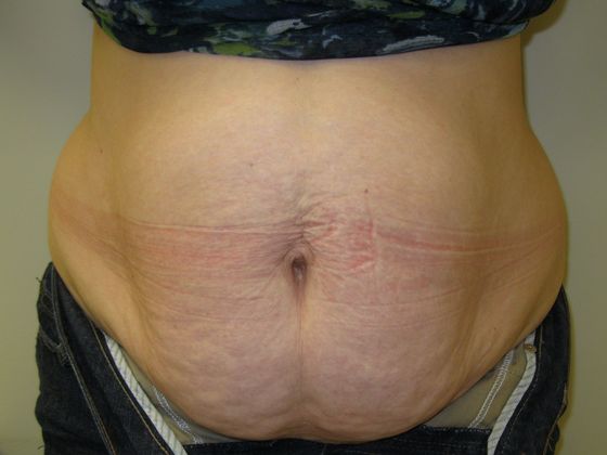 Tummy Tuck Case 9 - Before
