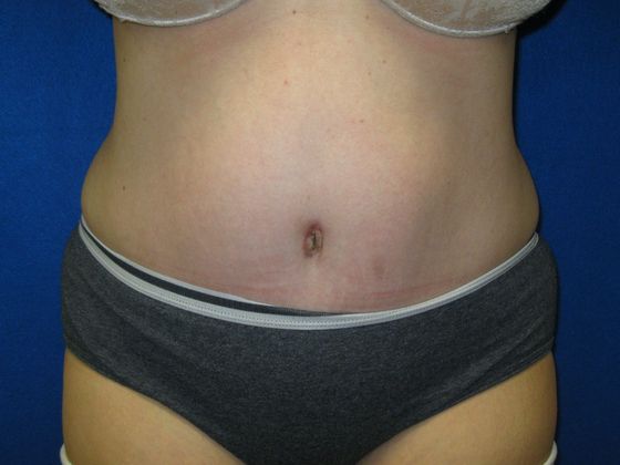 Tummy Tuck Case 9 - After