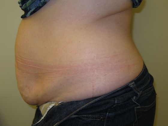 Tummy Tuck: Case 9 - Before
