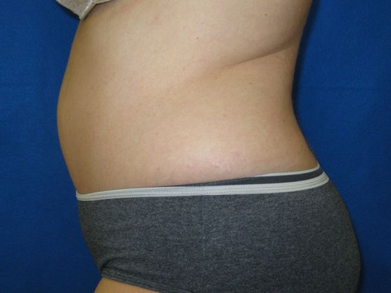 Tummy Tuck: Case 9 - After