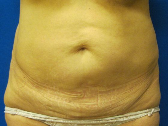 Tummy Tuck Case 10 - Before