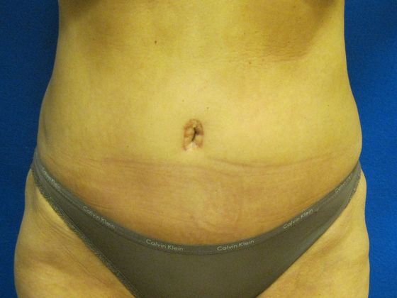 Tummy Tuck Case 10 - After
