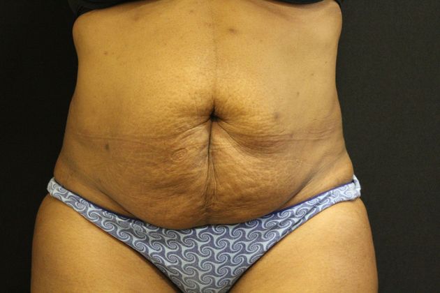 Tummy Tuck Case 12 - Before
