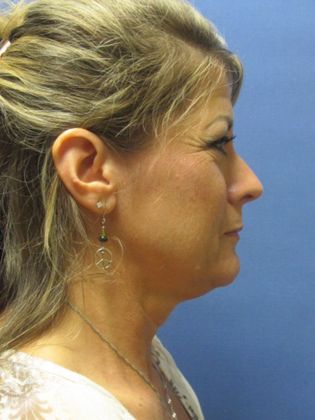 Facelift / RestoreLift Case 9 - Before