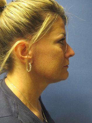 Facelift / RestoreLift Case 9 - After