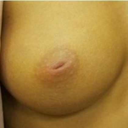 Inverted Nipple Repair Case 3 - Before