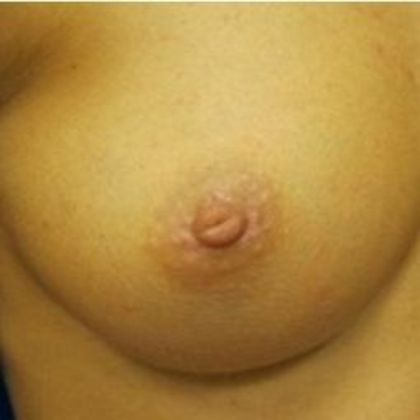 Inverted Nipple Repair Case 3 - After