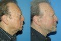 Facelift
