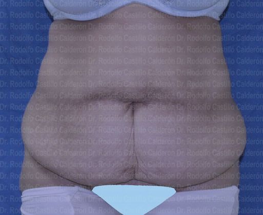 Post Bariatric Plastic Surgery Belt lipectomy after losing 90 lbs - Before