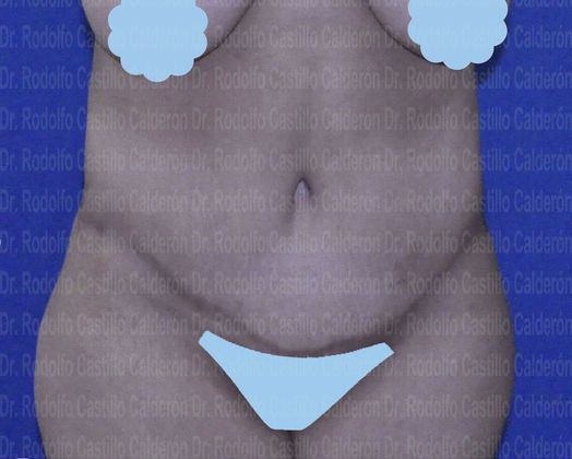 Post Bariatric Plastic Surgery Belt lipectomy after losing 90 lbs - After