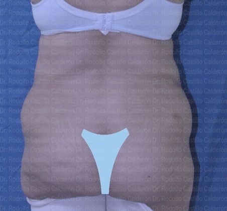 Post Bariatric Plastic Surgery: Belt lipectomy after losing 90 lbs - Before Belt lipectomy posterior view