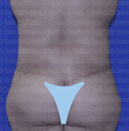Post Bariatric Plastic Surgery: Belt lipectomy after losing 90 lbs - After Belt lipectomy posterior view