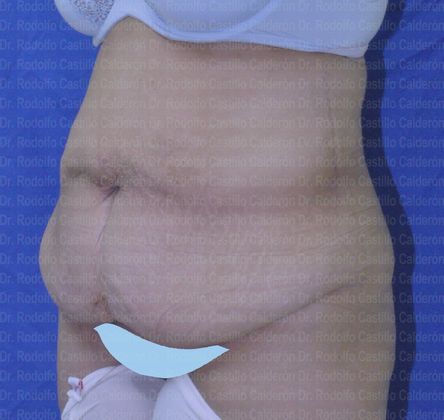 Post Bariatric Plastic Surgery: Belt lipectomy after losing 90 lbs - Before belt lipectomy oblique view