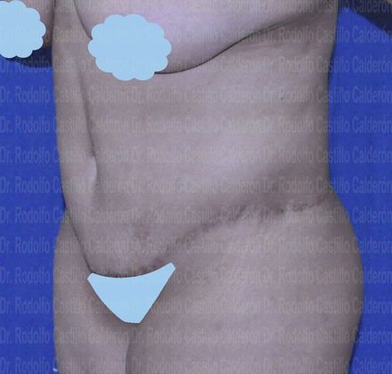 Post Bariatric Plastic Surgery: Belt lipectomy after losing 90 lbs - After Belt lipectomy oblique view