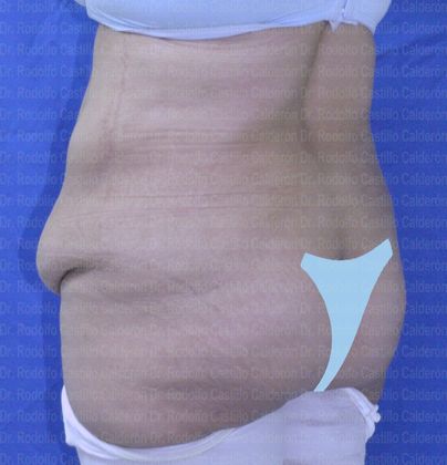 Post Bariatric Plastic Surgery: Belt lipectomy after losing 90 lbs - before belt lipectomy oblique posterior view