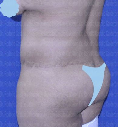 Post Bariatric Plastic Surgery: Belt lipectomy after losing 90 lbs - After belt lipectomy oblique posterior view