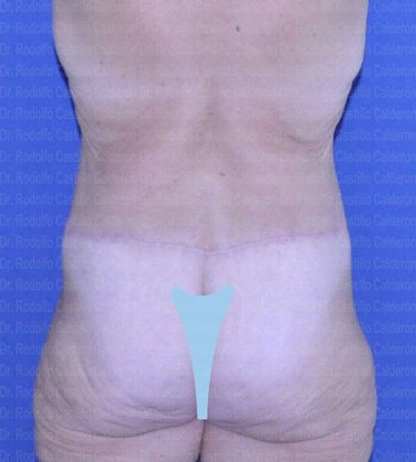 Post Bariatric Plastic Surgery: Belt Lipectomy after losing 160 lbs - After Belt lipectomy posterior view