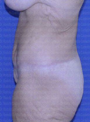 Post Bariatric Plastic Surgery: Belt Lipectomy after losing 160 lbs - After belt Lipectomy lateral view
