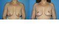 Mastopexy