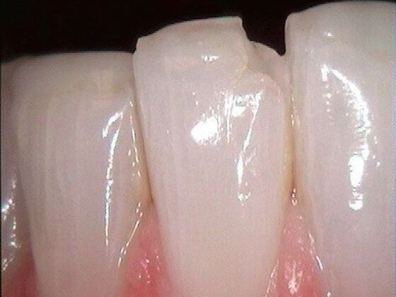 Tooth Colored Fillings Case 5 - Before