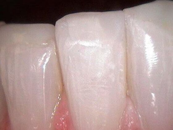 Tooth Colored Fillings Case 5 - After