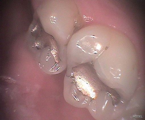 Tooth-colored Fillings Cases