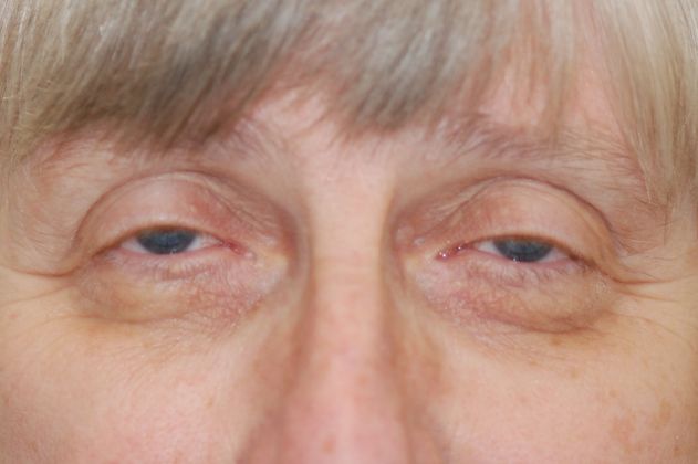 Ptosis Repair Case 32 - Before