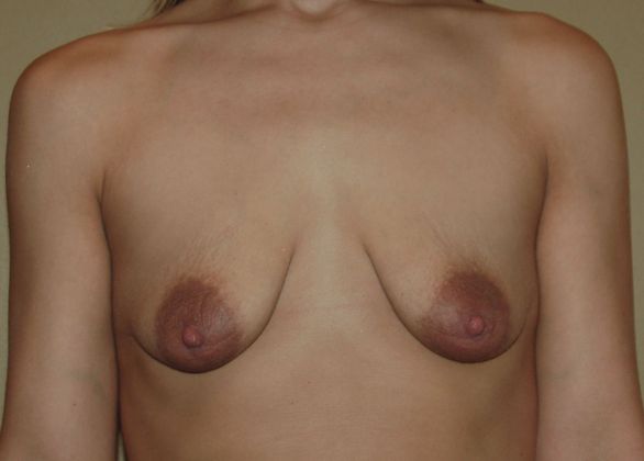 Breast Augmentation w/ Lift Case 116 - Before