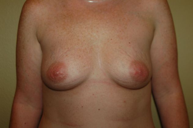 Mommy Makeover Case 47 - Before