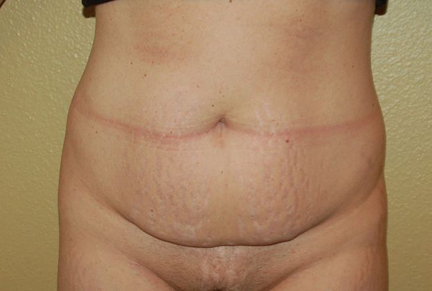 Mommy Makeover Case 47 - After