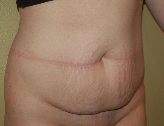 Mommy Makeover: Case 47 - Before