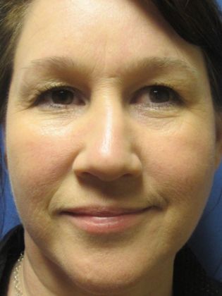 Eyelid Surgery (Blepharoplasty) Case 6 - Before