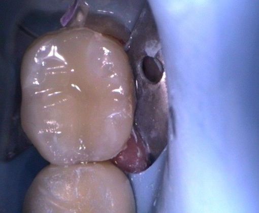 Cerec: Case 1 - Cerec porcelain inlay