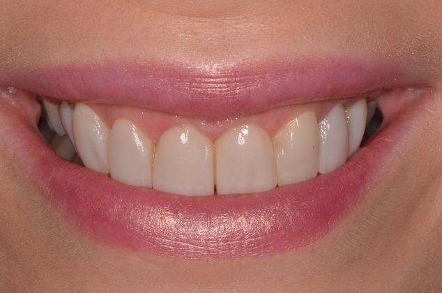 Composite Bonding: Case 1 - After composite smile design