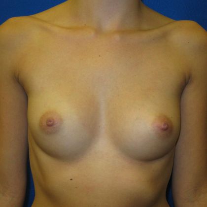 Breast Augmentation Case 1 - Before