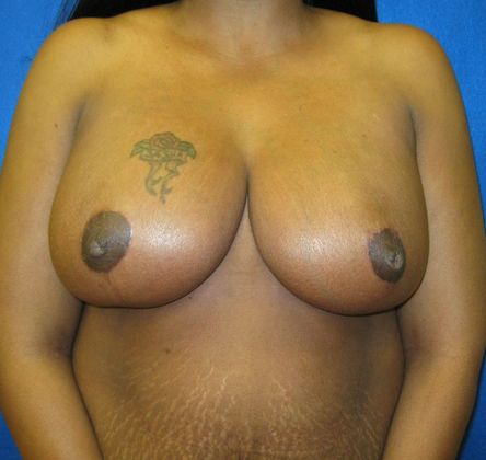 Breast Reduction Case 12 - After