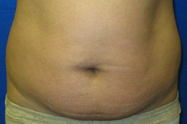 Tummy Tuck Case 11 - Before