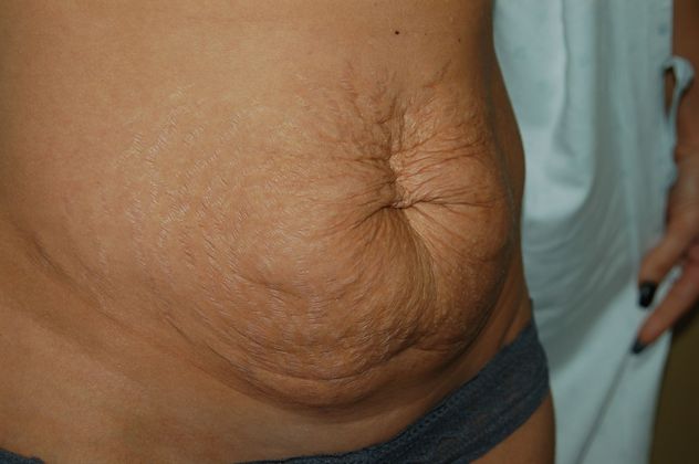 Mommy Makeover: Case 50 - Before